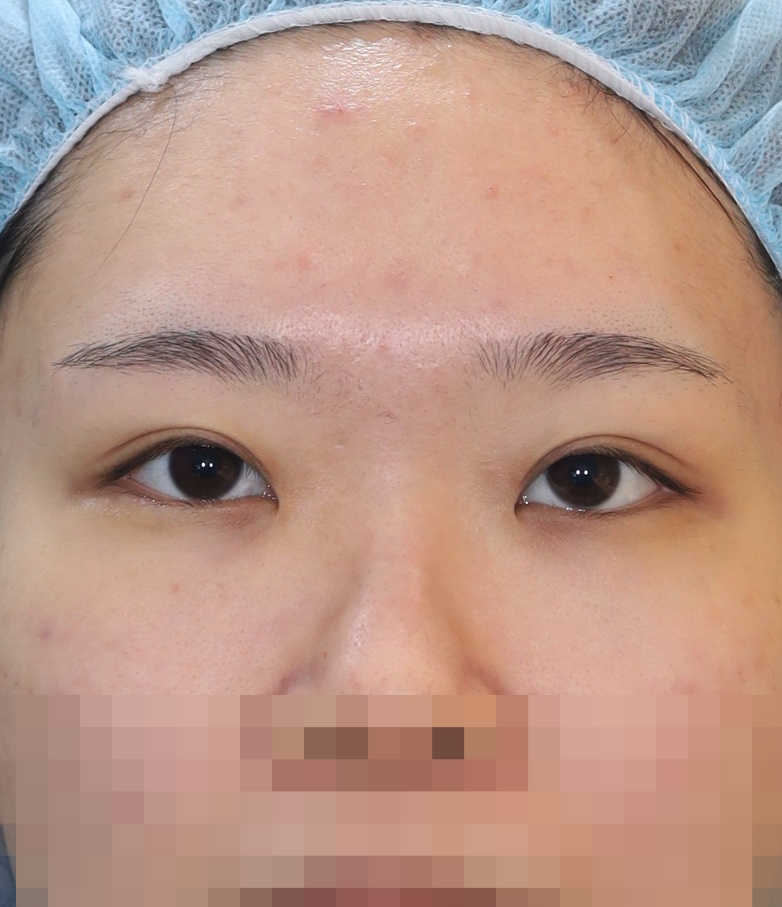 Before