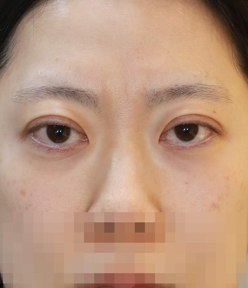 쌍꺼풀 라인 낮추기; 두줄따기 수술전