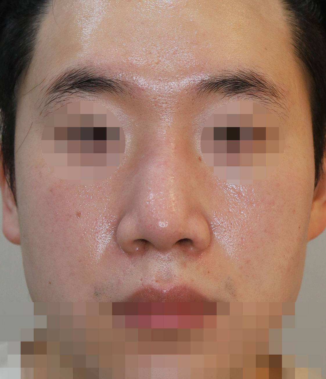 반영구 필러 제거, 무보형물 코성형; 매부리 교정 4개월 수술후