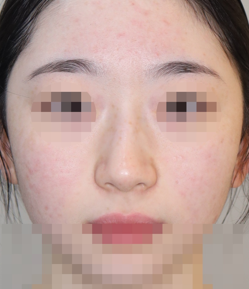 무보형물 코성형; 휜코 교정, 매부리 교정 3개월 수술전
