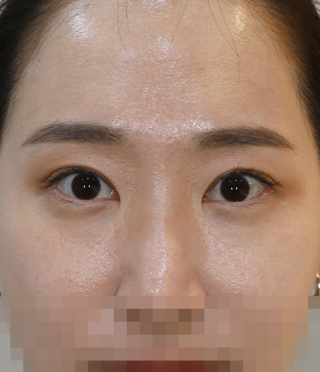 절개 쌍꺼풀 재수술 3개월 수술후