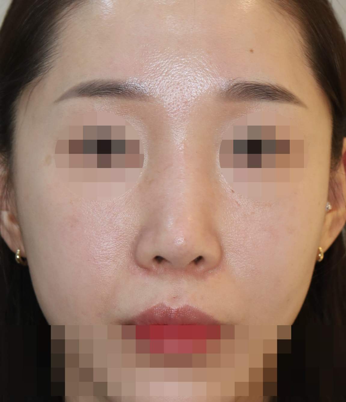 무보형물 코재수술; 눌린코 교정 수술후