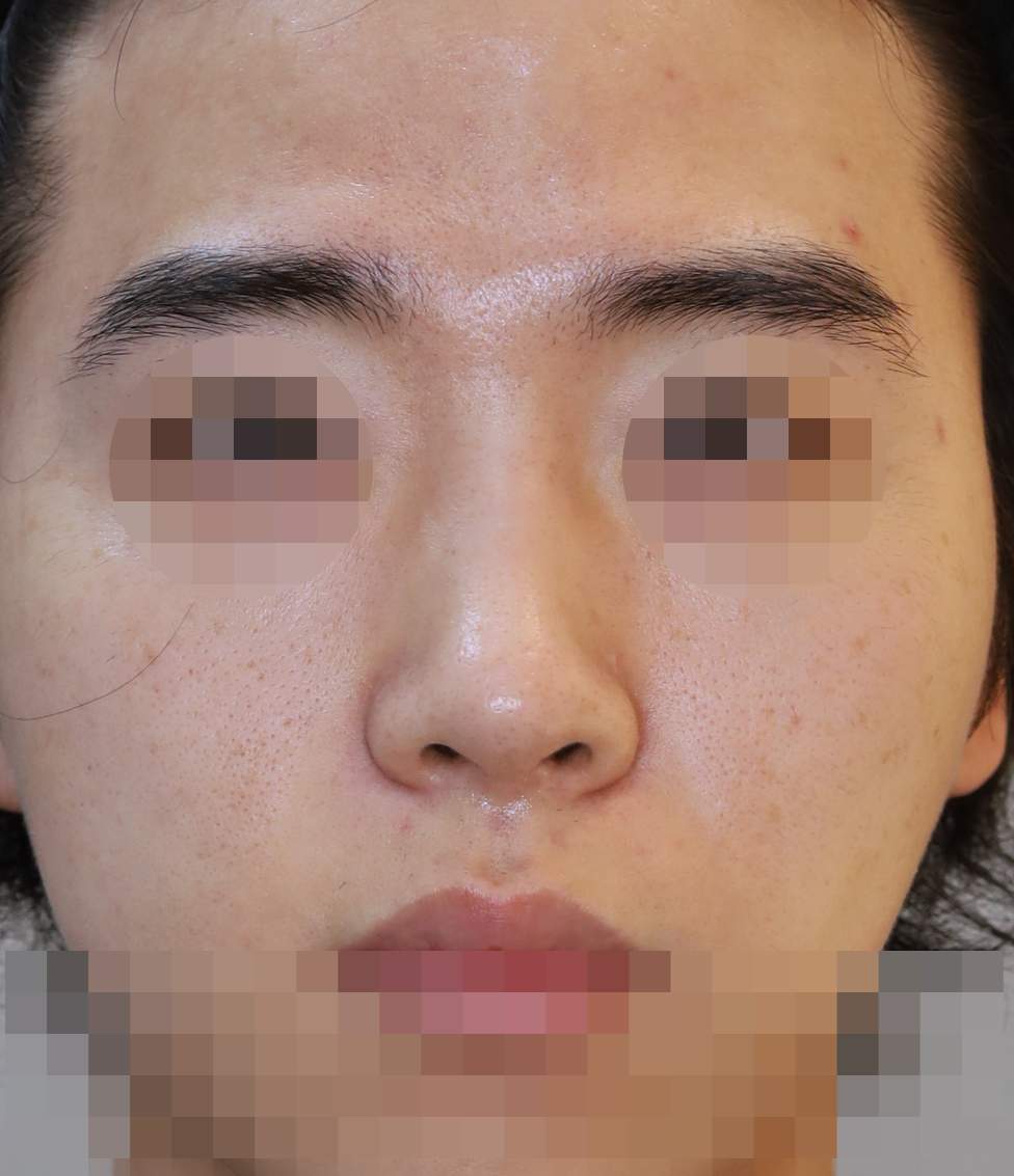 무보형물 코성형; 휜코 교정, 매부리 교정 수술후