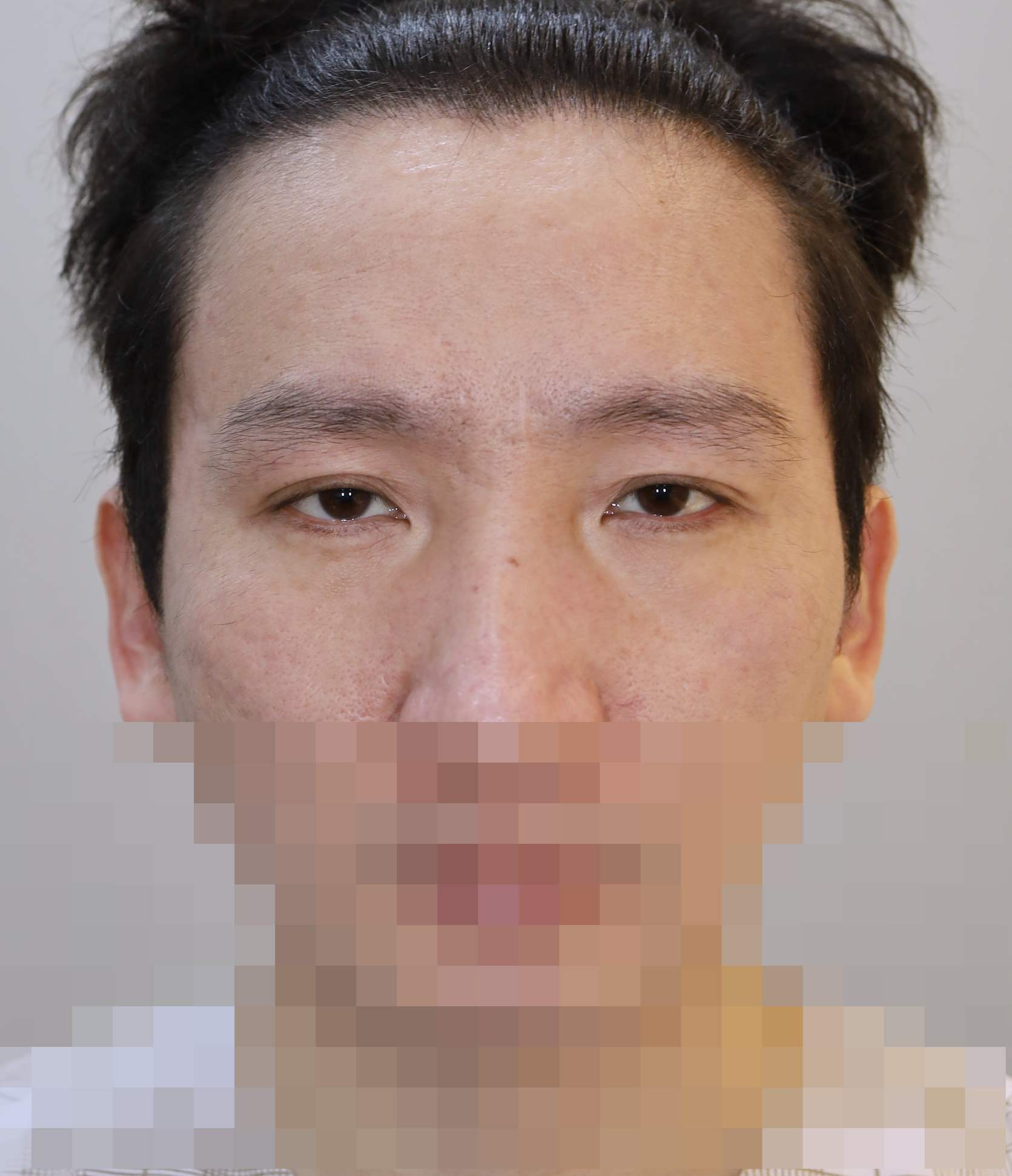 쌍꺼풀 라인 낮추기; 두줄따기, 이마 축소 거상 11개월 수술전