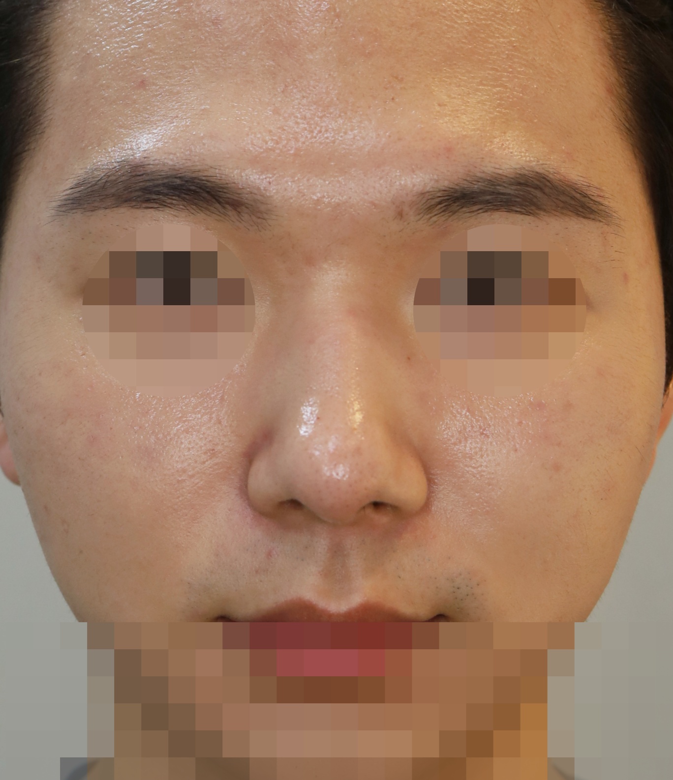 무보형물 코성형; 비순각 교정 수술후