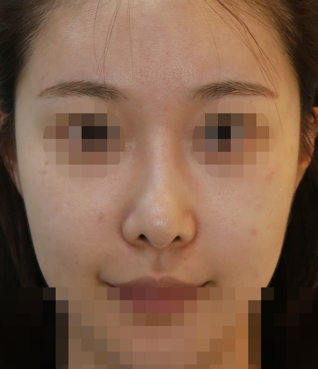 콧대(맞춤보형물), 코끝(귀연골), 비주올리기 수술전