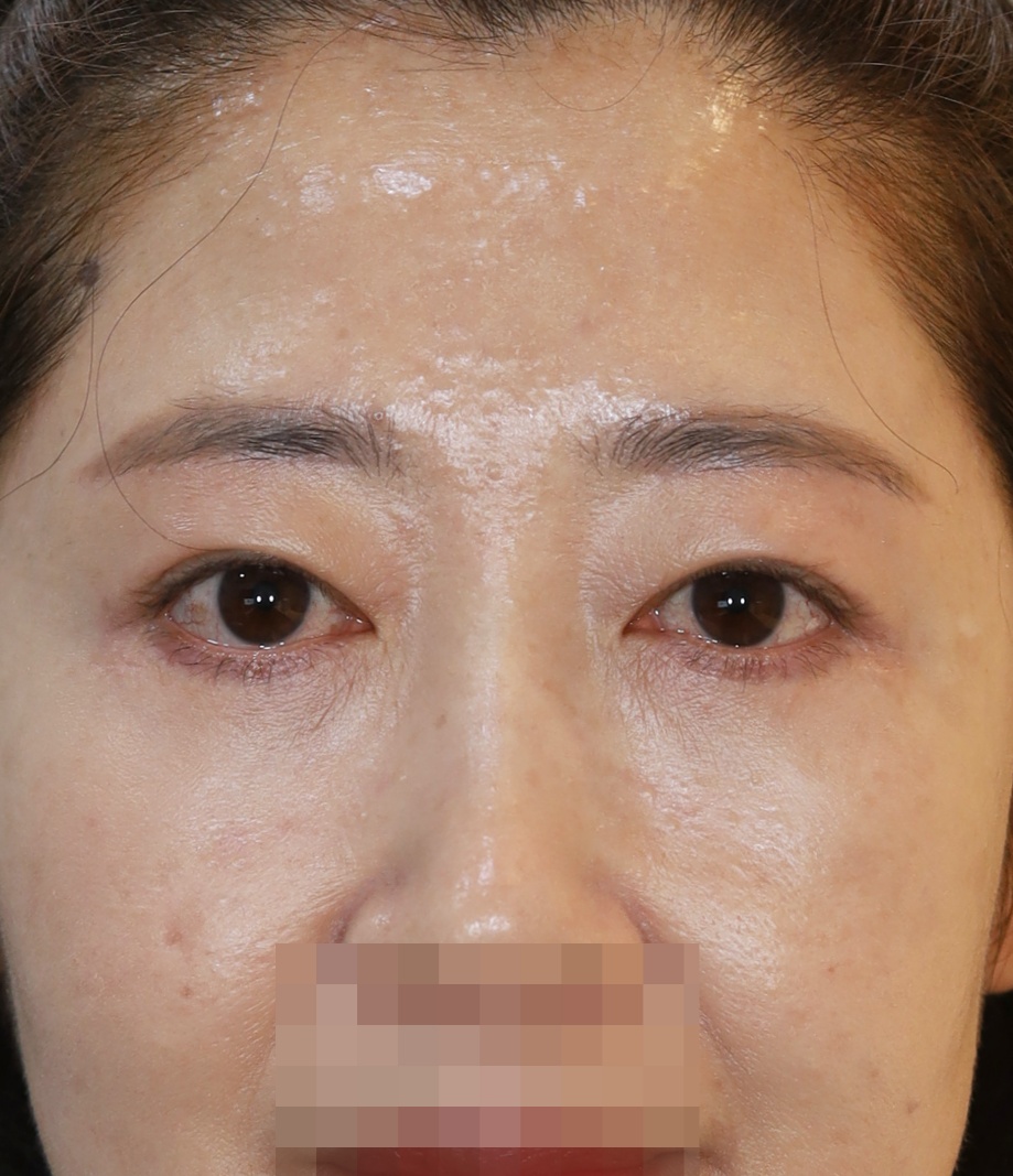 눈썹 밑 거상, 비절개 쌍꺼풀, 중안면 거상 4개월 수술후