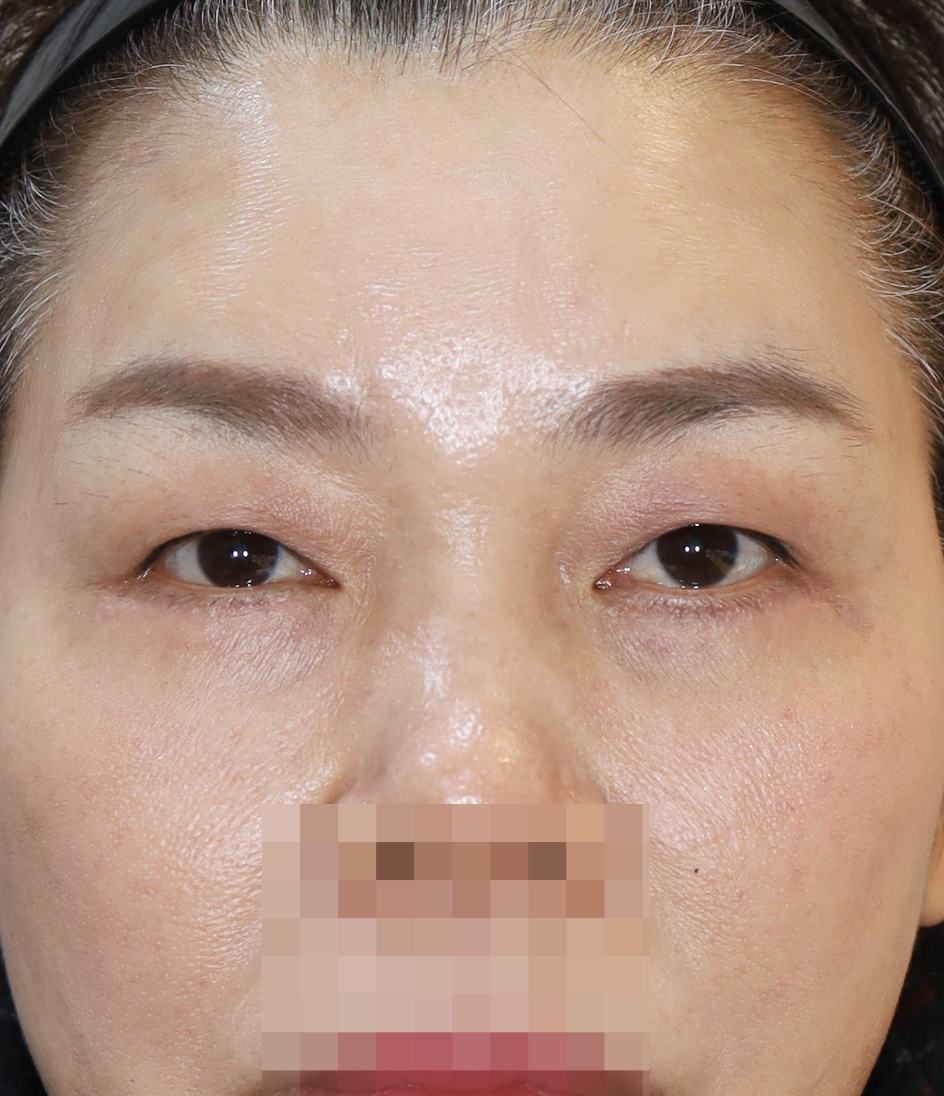 중안면 거상 3개월 수술후