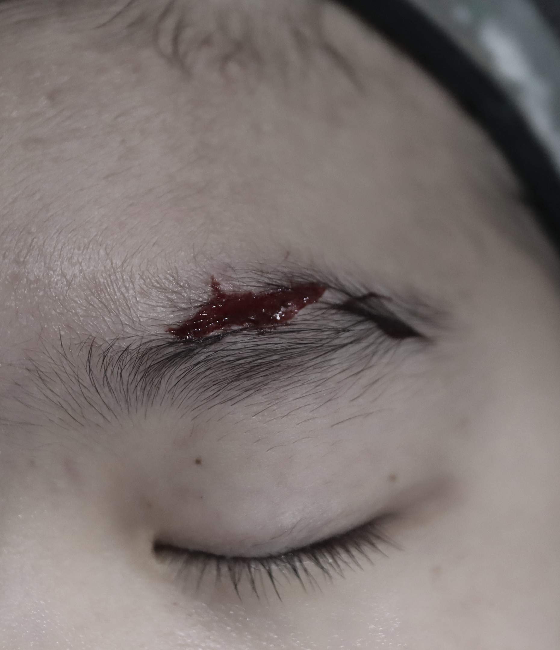 열상봉합, 흉터관리패키지 4개월 수술전