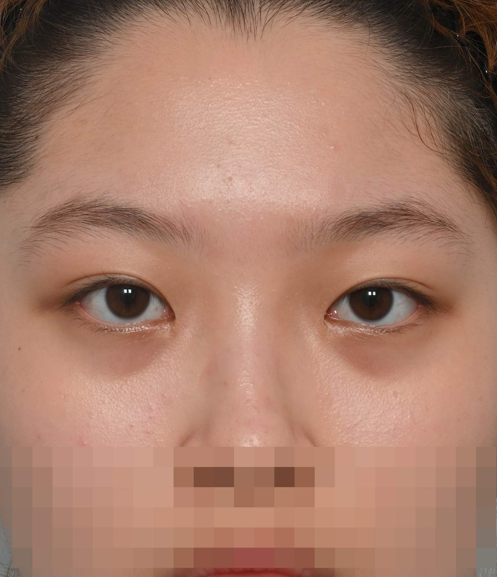 비절개 쌍꺼풀, 앞 위 트임 수술후