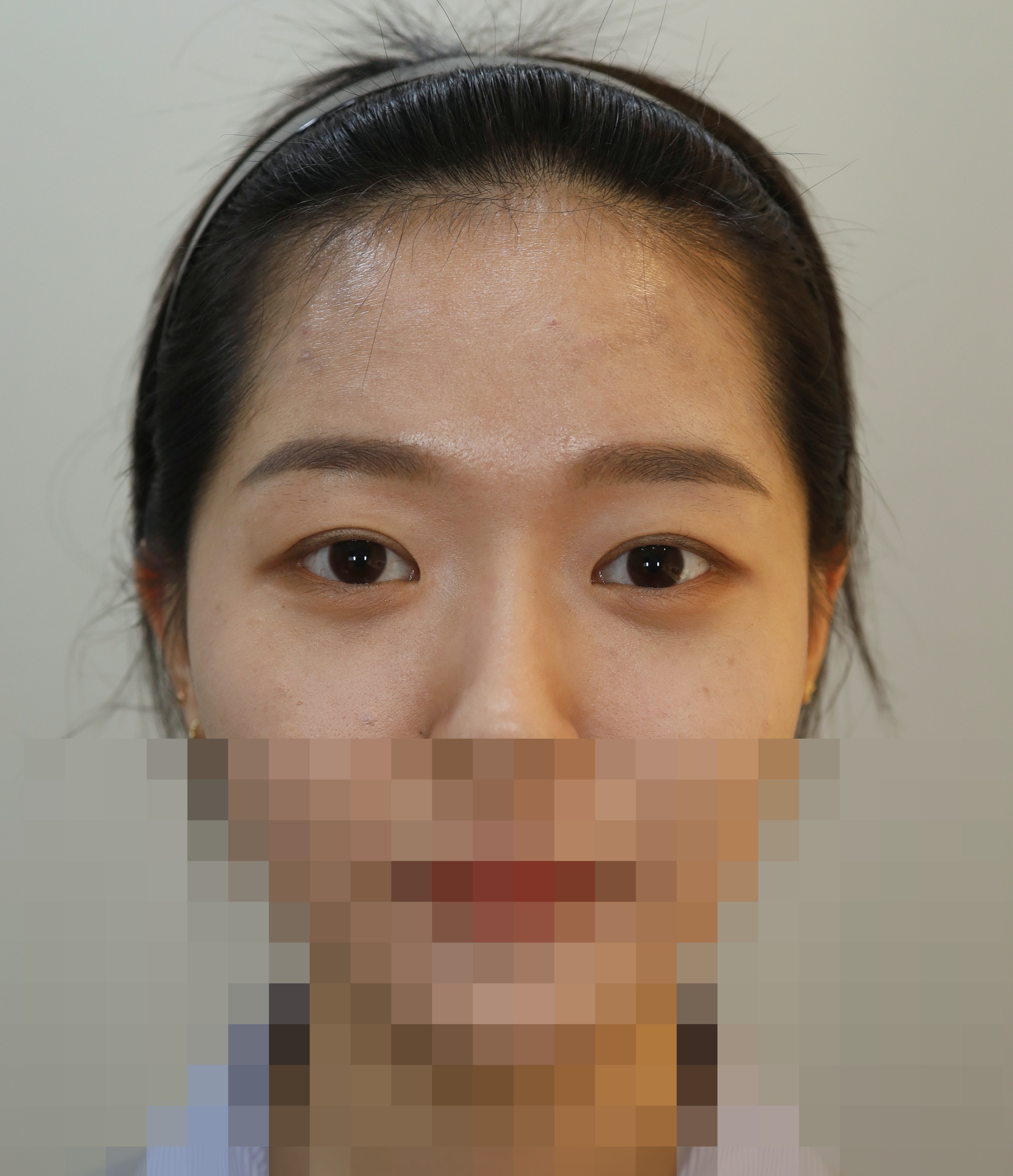 이마 거상 3개월 수술후