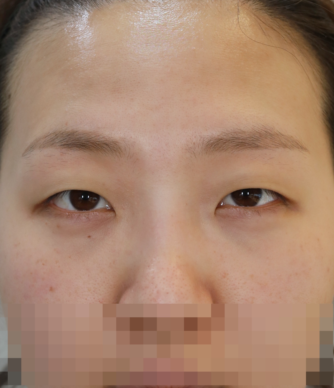 비절개 쌍꺼풀, 위트임 5개월 수술전