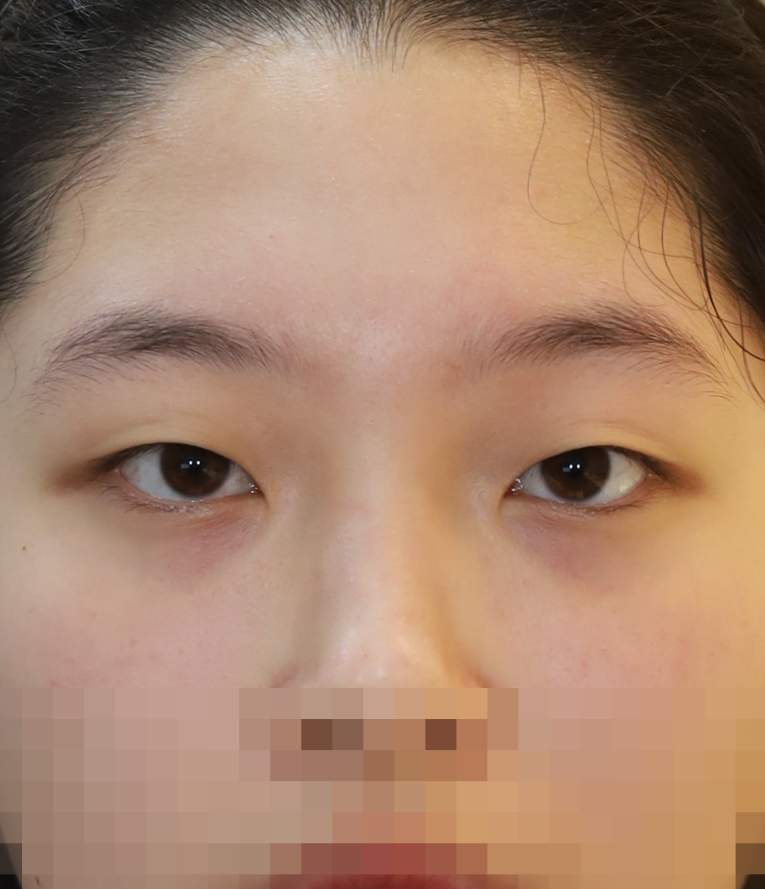 비절개 쌍꺼풀, 앞 위 트임 수술전