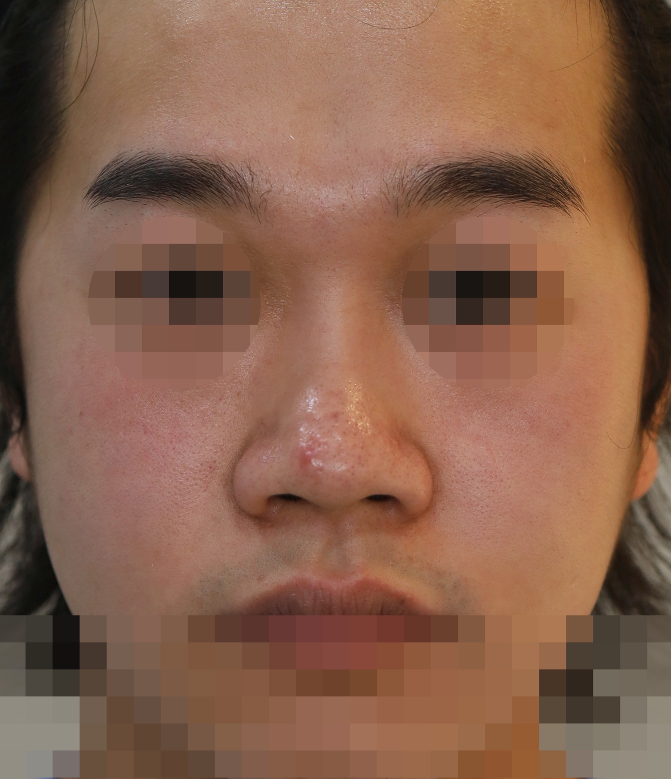콧대(맞춤보형물), 코끝(귀연골), 비주내리기 5개월 수술전