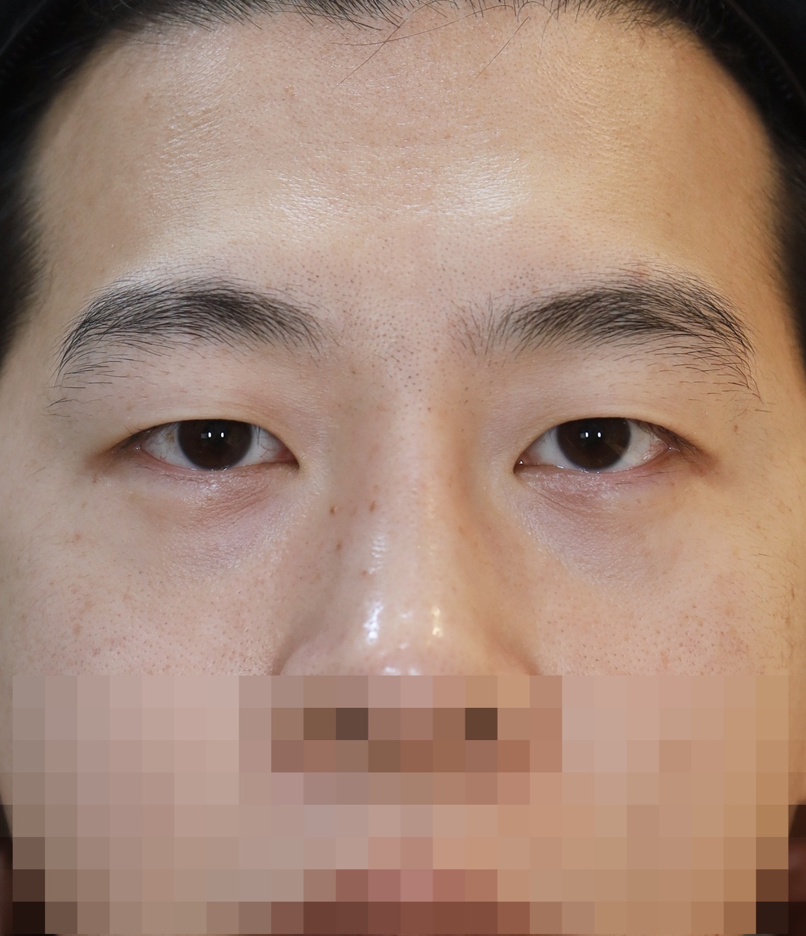 비절개 쌍꺼풀 2년 수술후