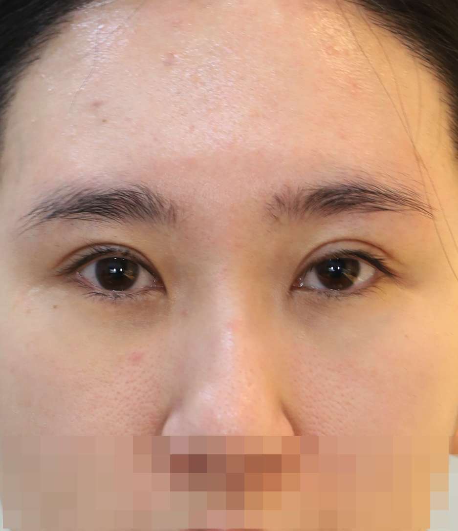 쌍꺼풀 라인 낮추기; 두줄따기 4개월 수술전