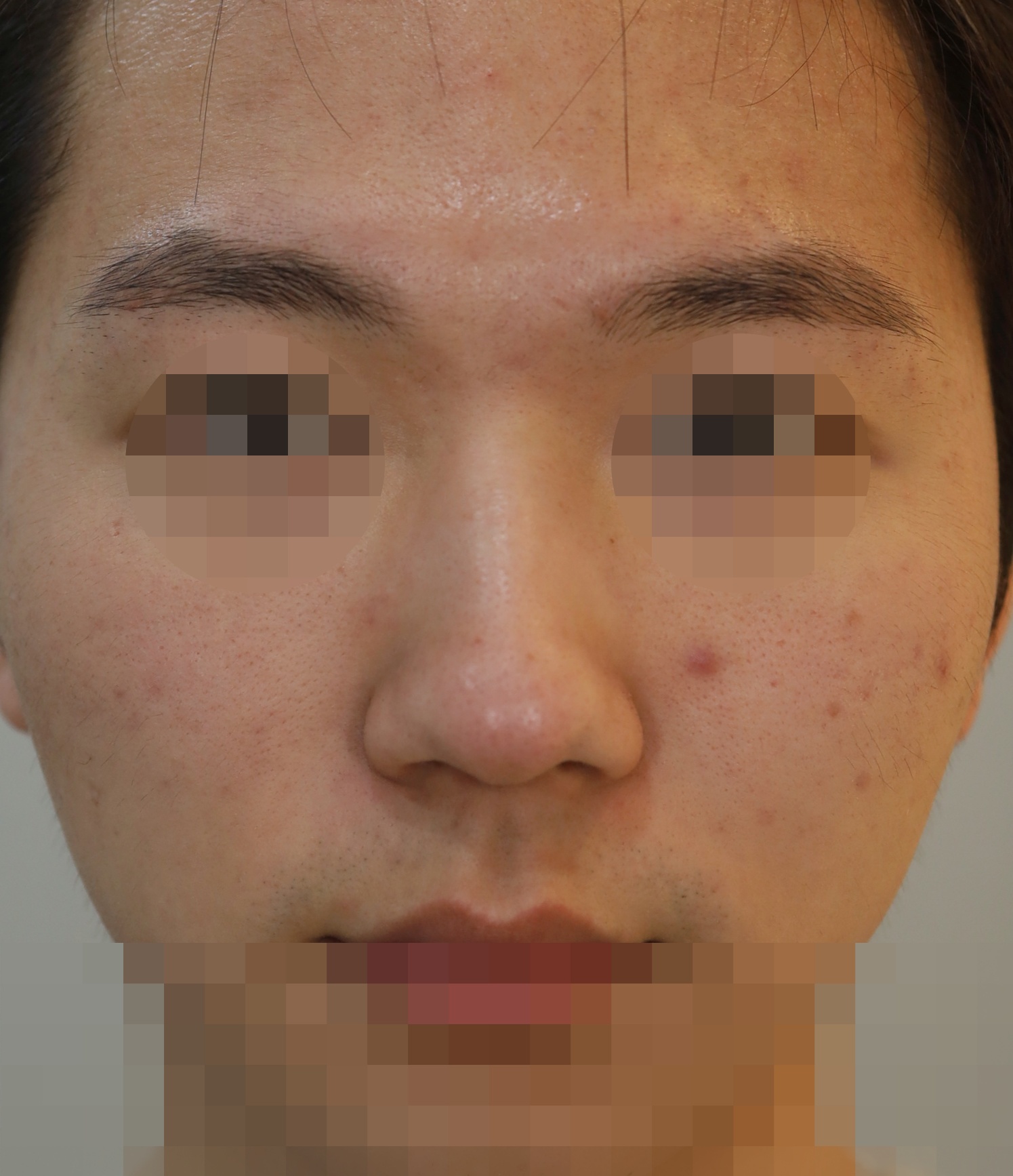 무보형물 코성형; 비순각 교정 수술전
