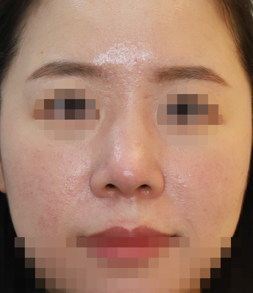 무보형물 코성형; 들린코 교정 수술후