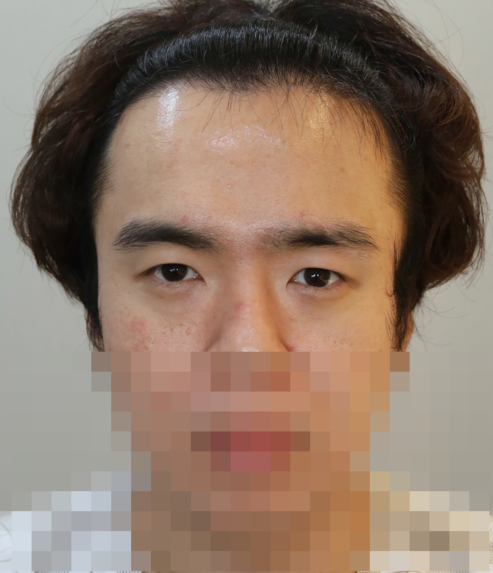 이마 축소 거상, 쌍꺼풀 재수술; 매몰법 5개월 수술전