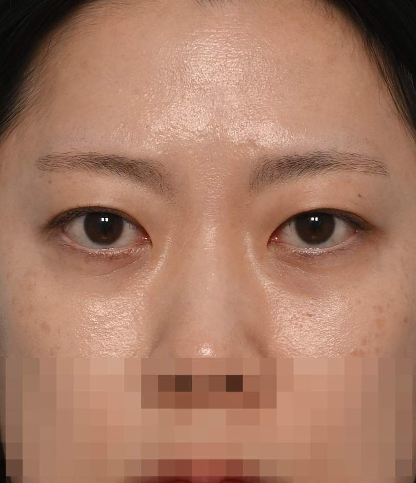 쌍꺼풀 라인 낮추기; 두줄따기 수술후
