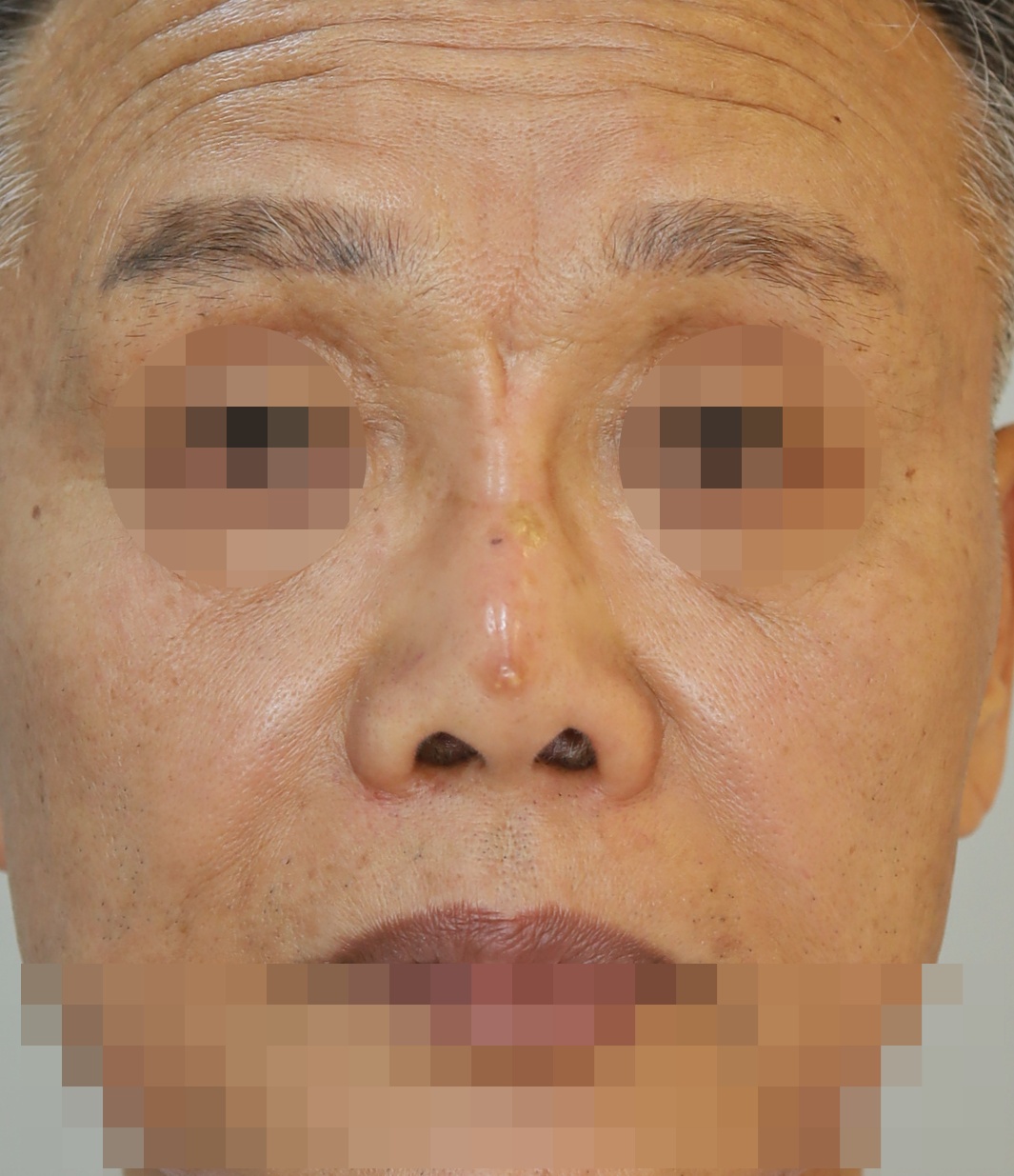 보형물 제거, 흉터성형, 구축코 교정, 코끝 복원 6개월 수술전
