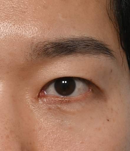 앞트임 복원, 두줄따기 수술후
