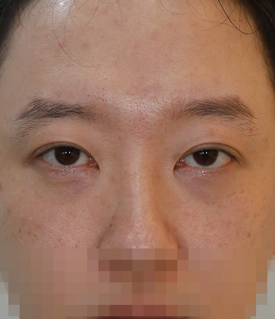 쌍꺼풀 라인 낮추기; 피부 절제법 7개월 수술전