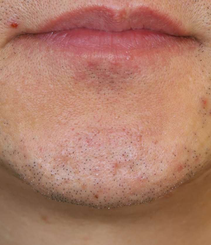 흉터성형술, 흉터 관리 패키지 9개월 수술후