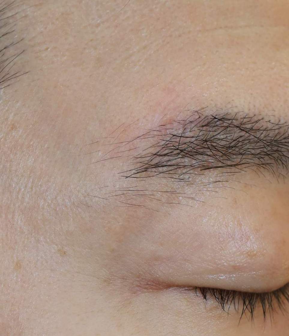 열상봉합, 흉터관리패키지 수술후