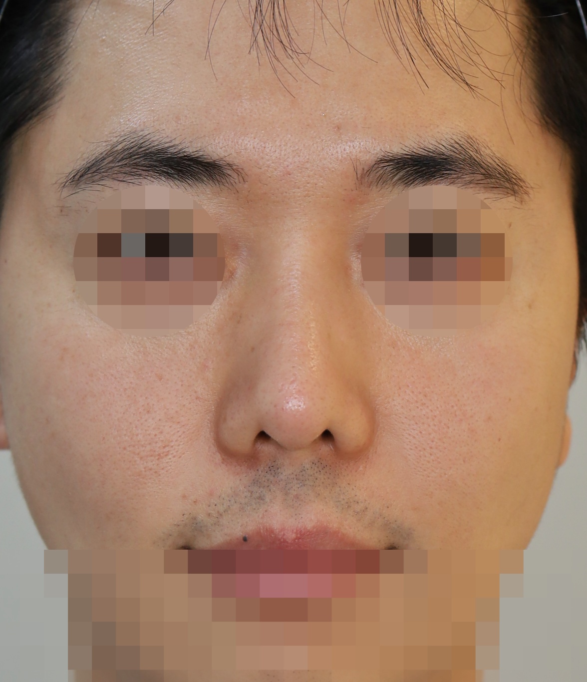 늑연골 제거, 보형물 제거, 코끝 복원 2년 수술전