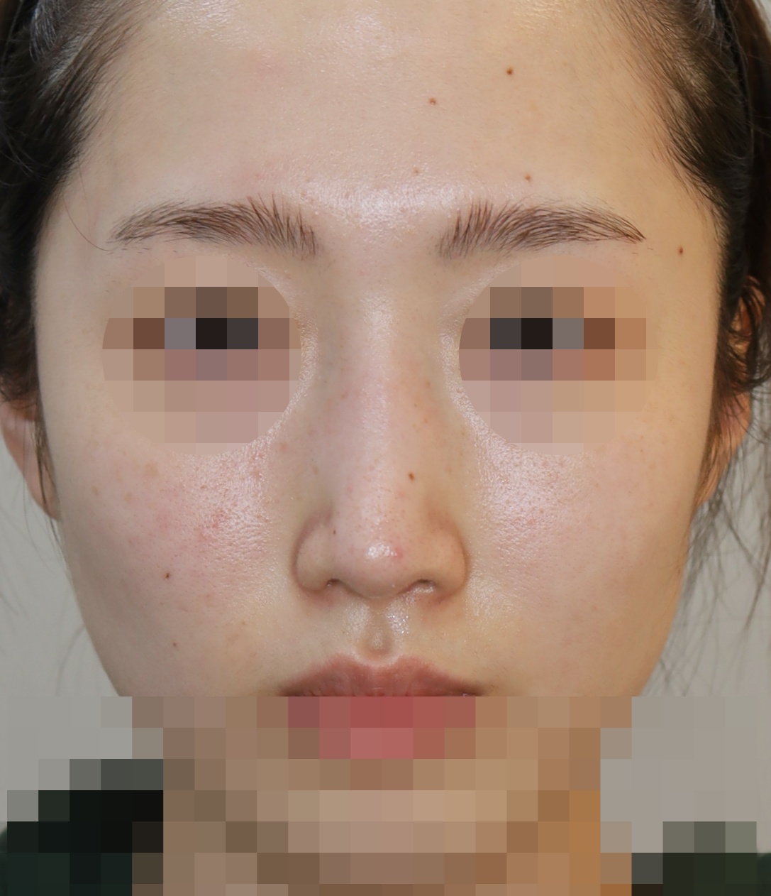 무보형물 코성형; 휜코 교정, 매부리 교정 3개월 수술후