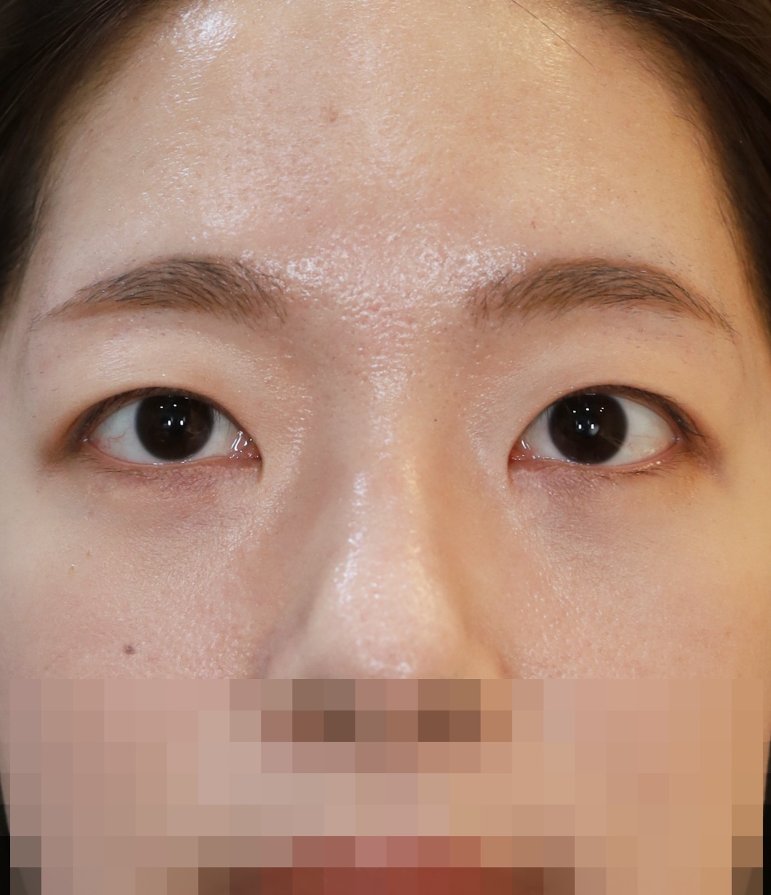 비절개 쌍꺼풀, 위트임, 눈밑 지방 재배치 2년 수술후