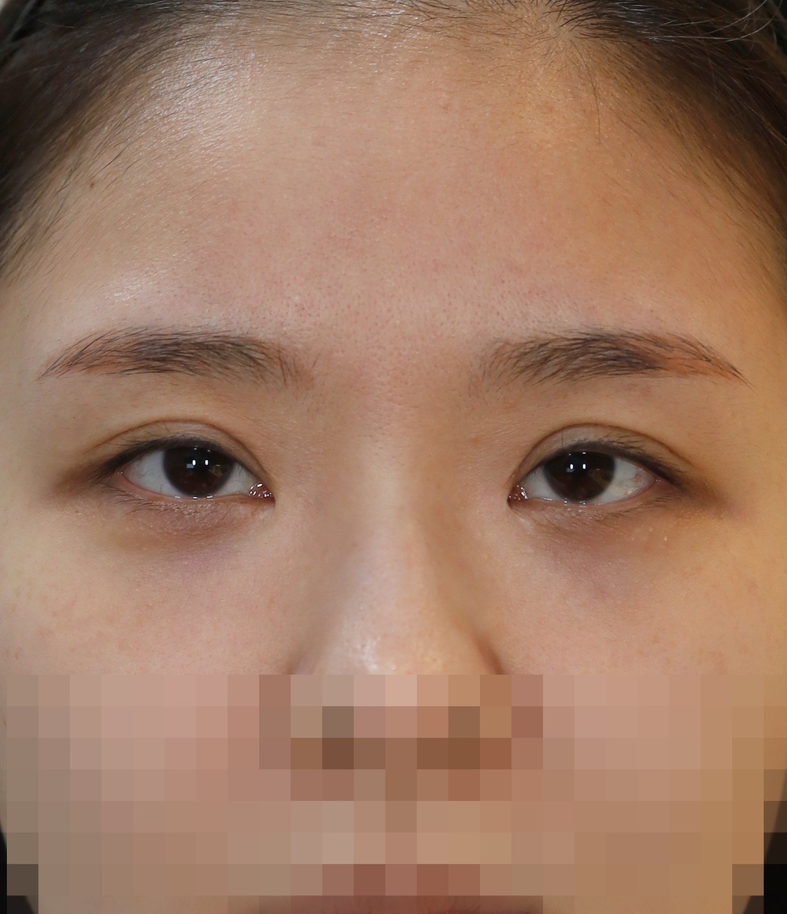 쌍꺼풀 라인 낮추기; 두줄따기 7개월 수술전