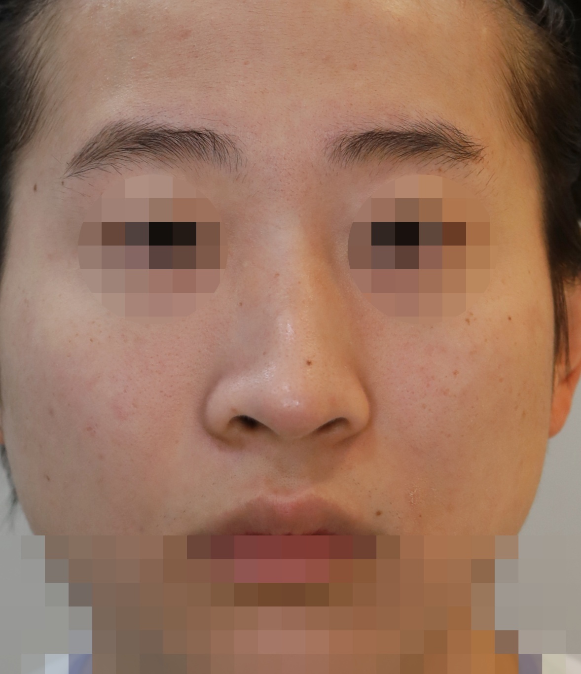 무보형물 코성형; 휜코 교정, 코끝 복원 5개월 수술전