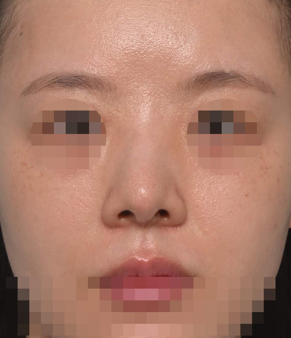 무보형물 코재수술; 연골입자 제거, 귀연골을 이용한 구축코 교정 2년 수술후