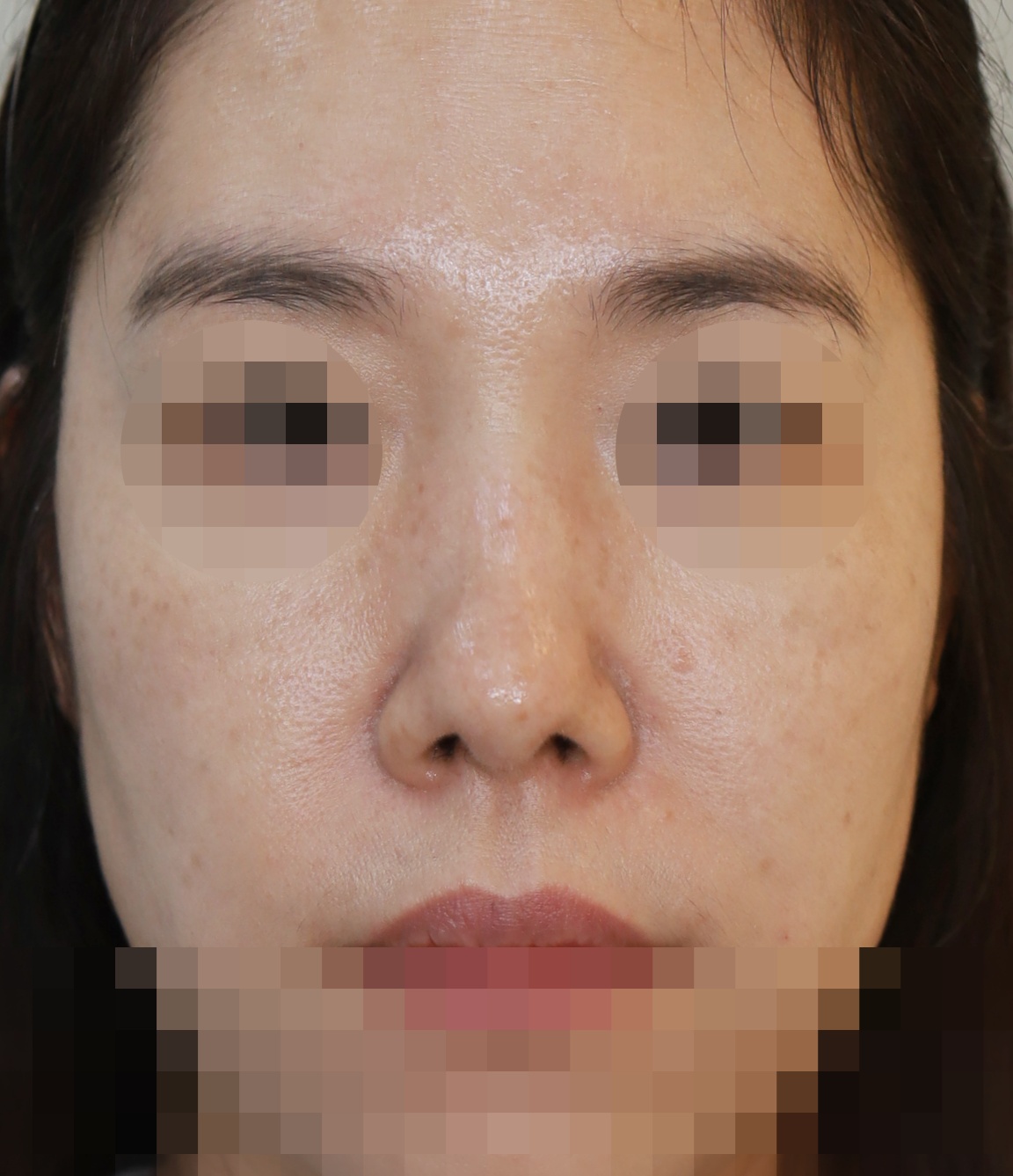 연골입자 제거, 코끝 복원 3개월 수술후