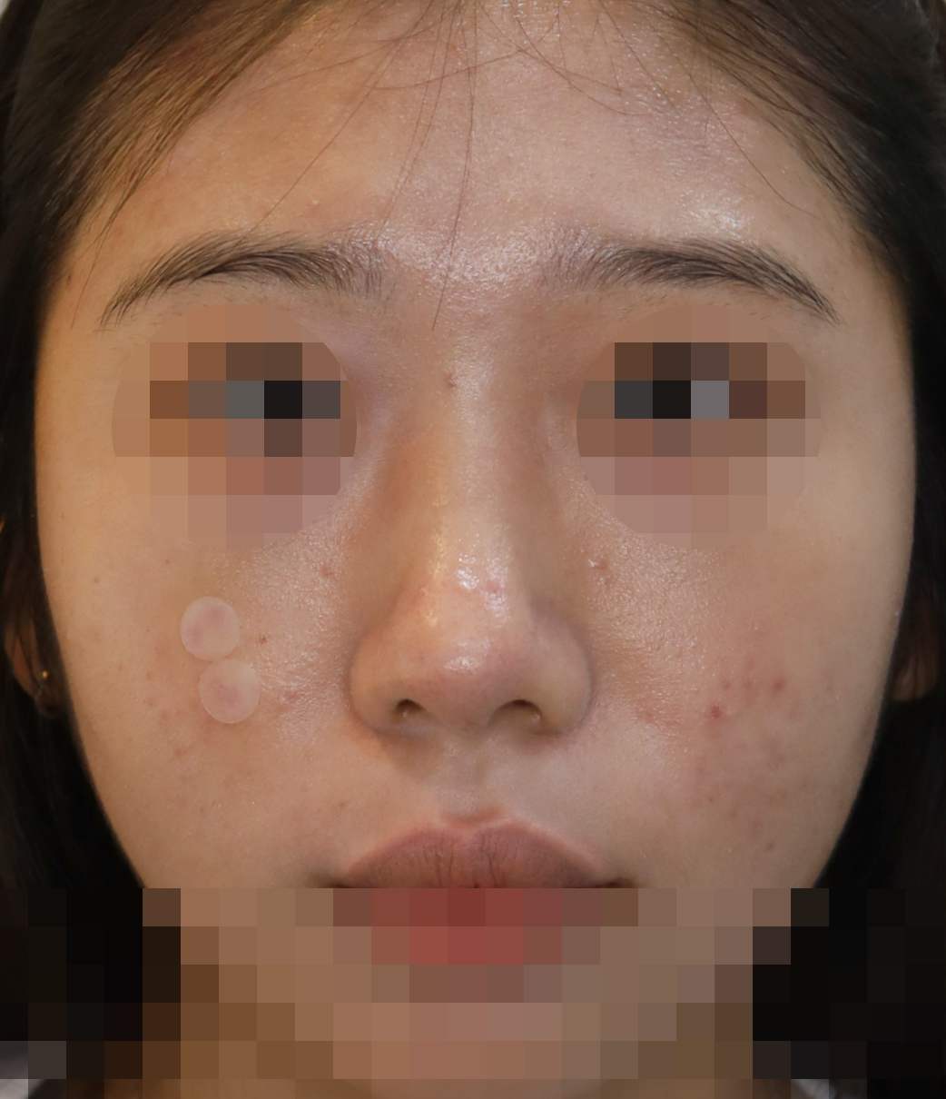무보형물 코성형; 복코 교정 수술후