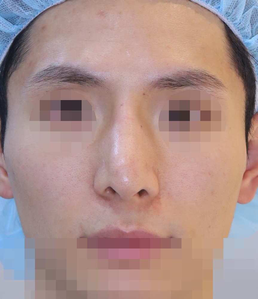 보형물 제거, 휜코 교정, 코끝 복원 3개월 수술전