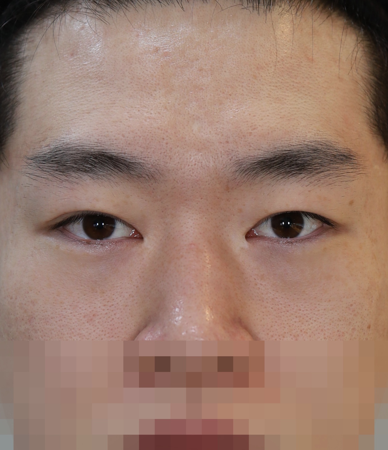 쌍꺼풀 라인 낮추기; 두줄따기, 앞트임 비대칭 교정 3개월 수술전