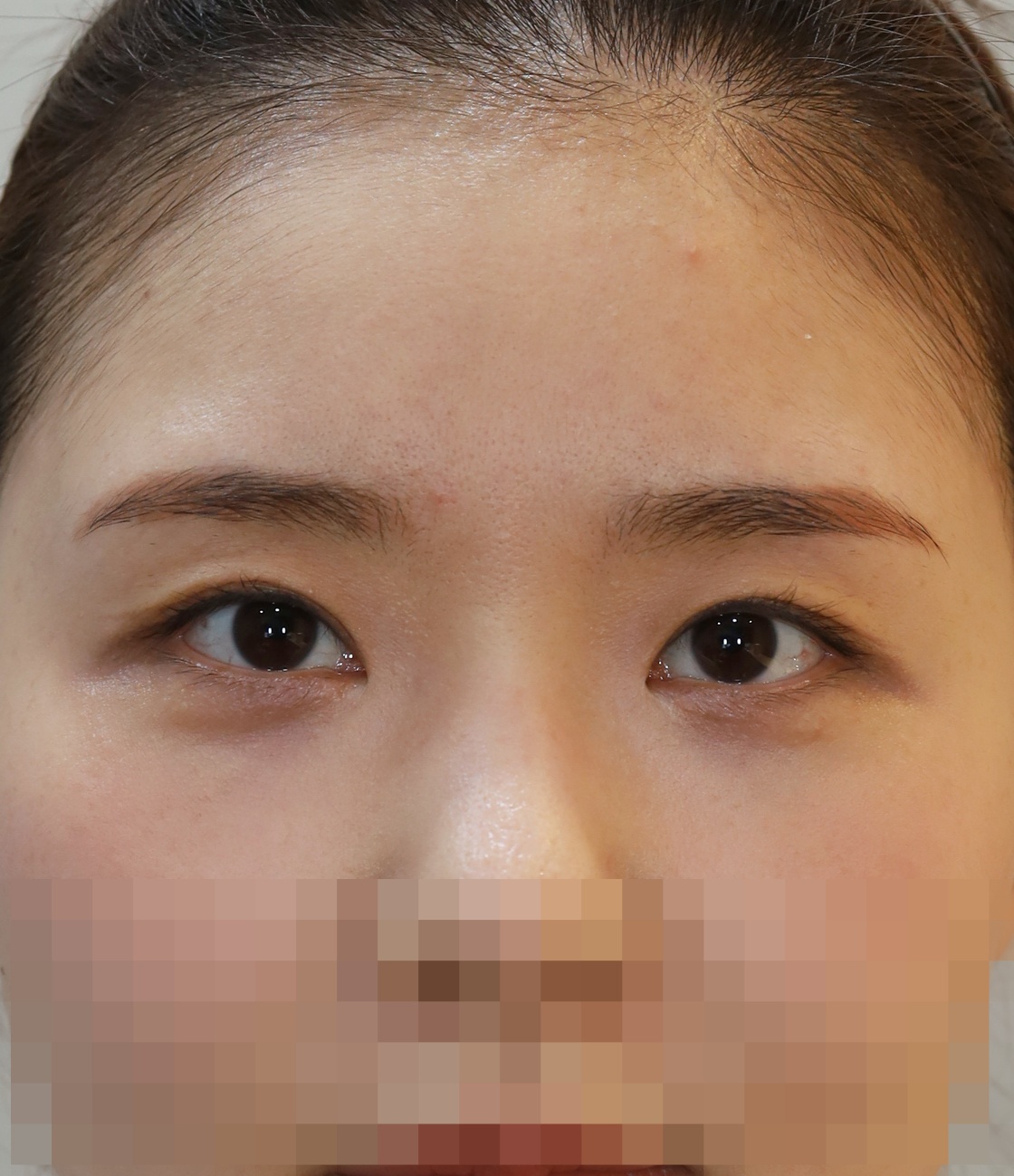 쌍꺼풀 라인 낮추기; 두줄따기 7개월 수술후