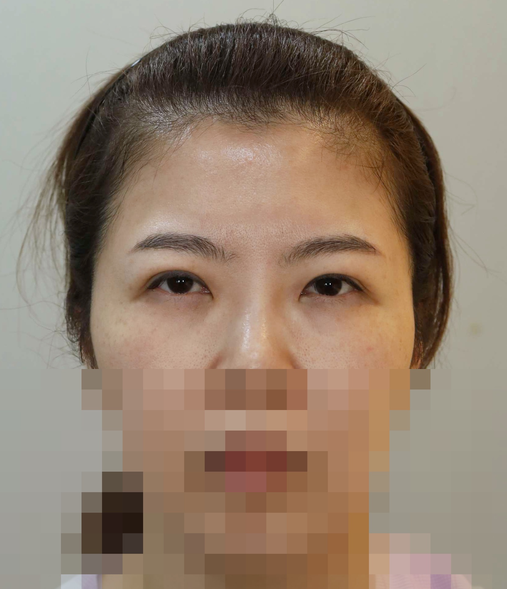 이마거상, 쌍꺼풀 라인 낮추기 재수술; 두줄따기 수술전