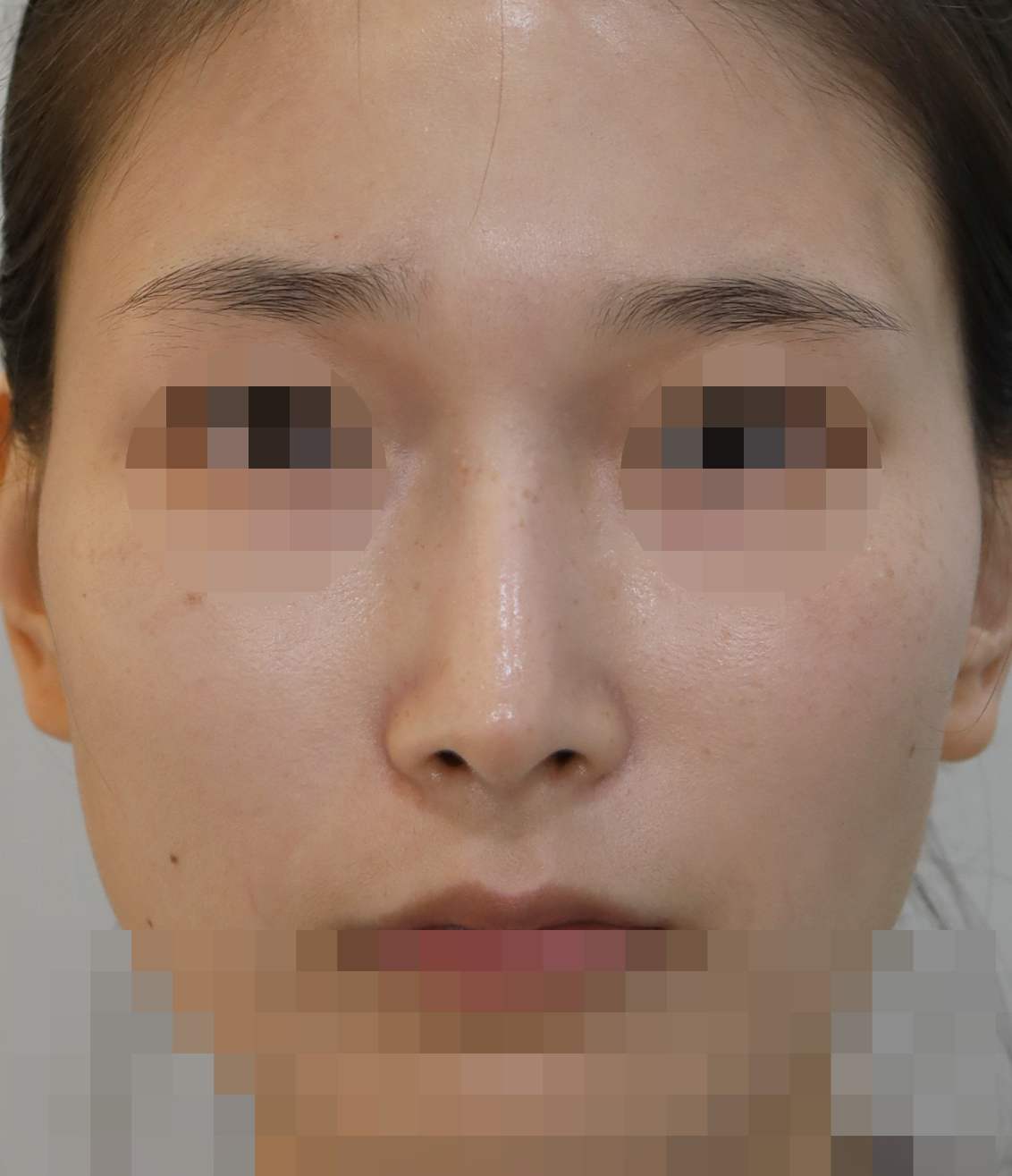 콧대(일반보형물), 코끝(귀연골), 비순각 교정 2년 수술후