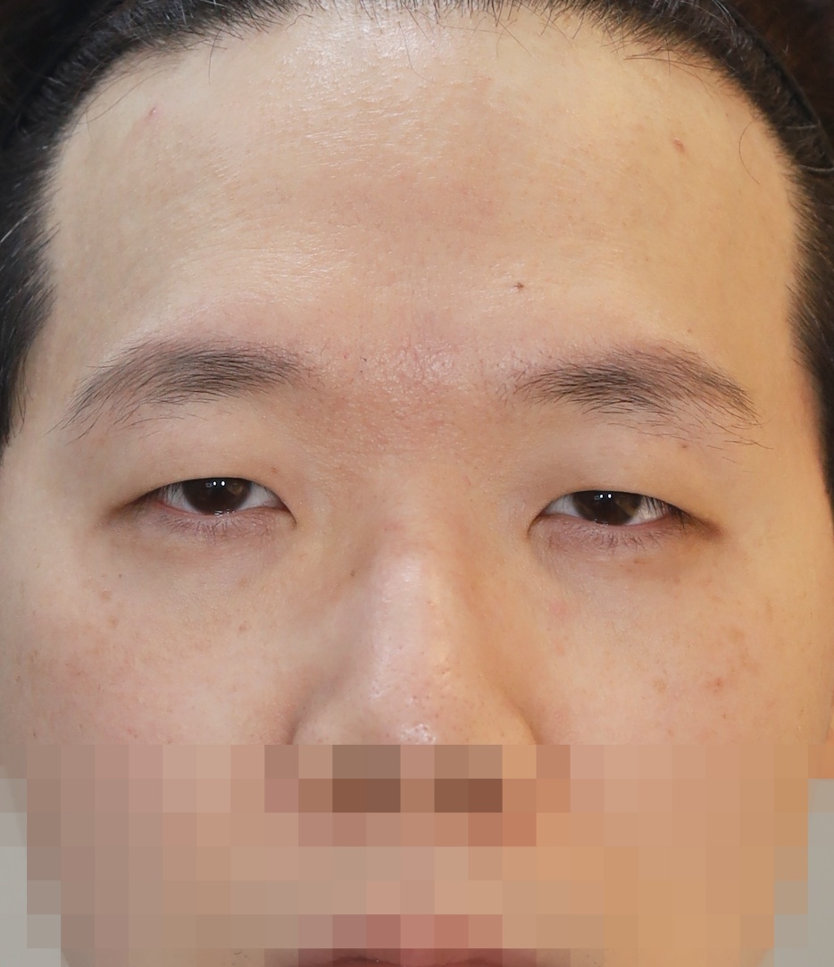 비절개 쌍꺼풀, 위트임 3개월 수술전