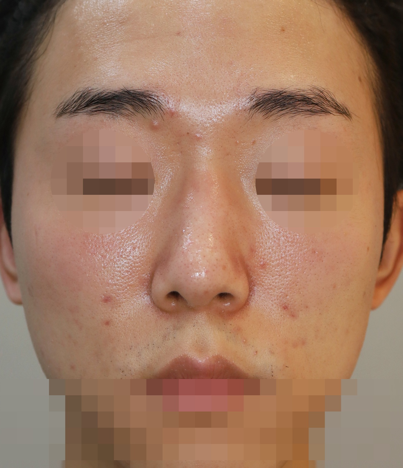 무보형물 코성형; 휜코 교정, 매부리 교정 11개월 수술후