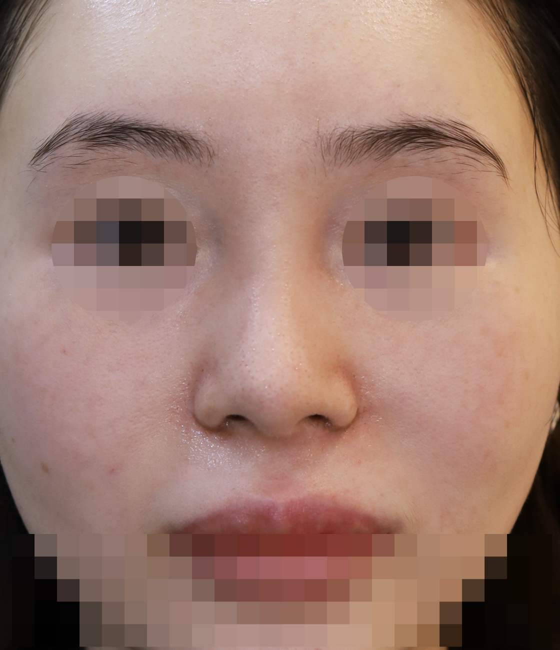 콧볼 재배치 2주 수술후