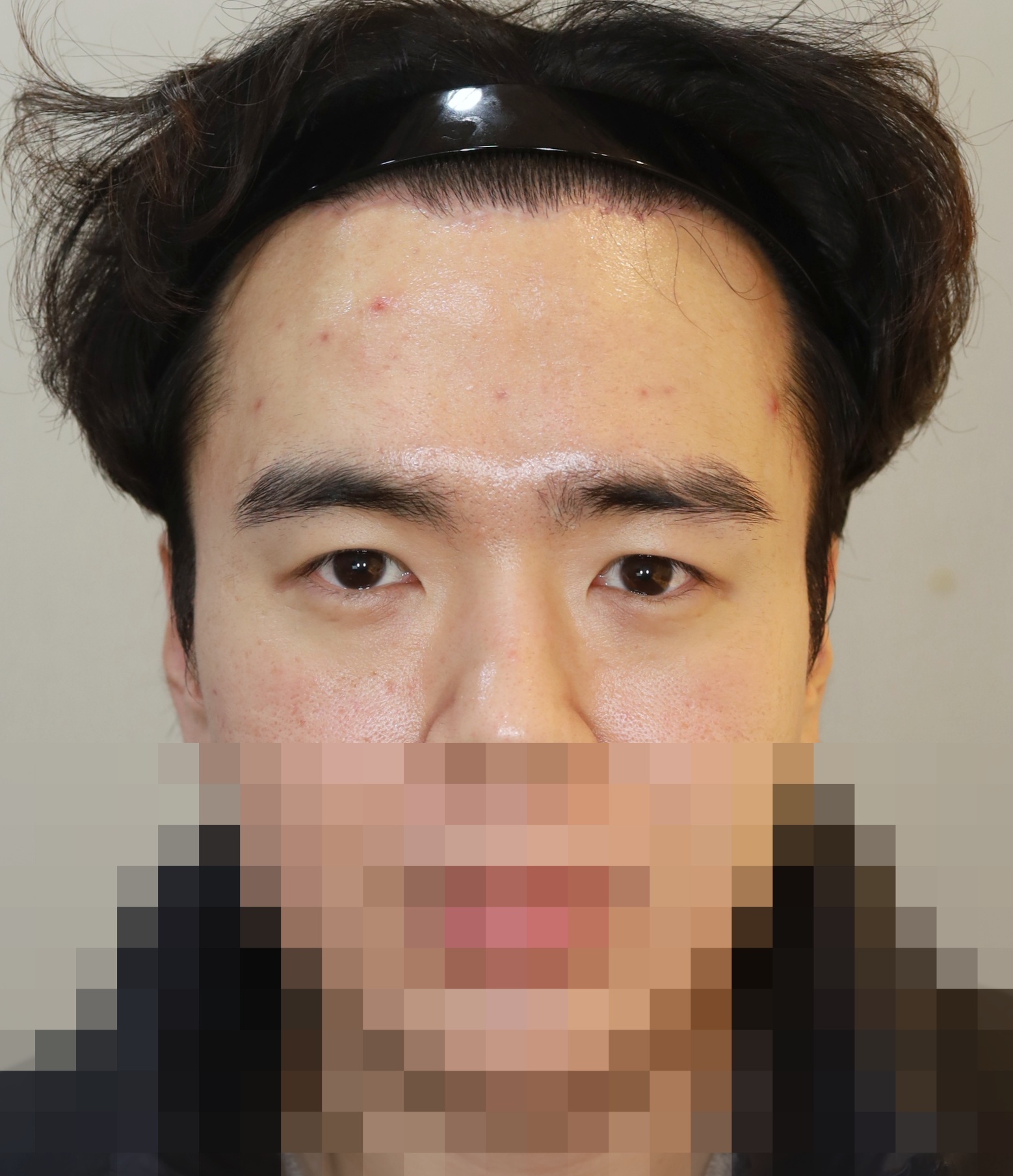 이마 축소 거상, 쌍꺼풀 재수술; 매몰법 5개월 수술후