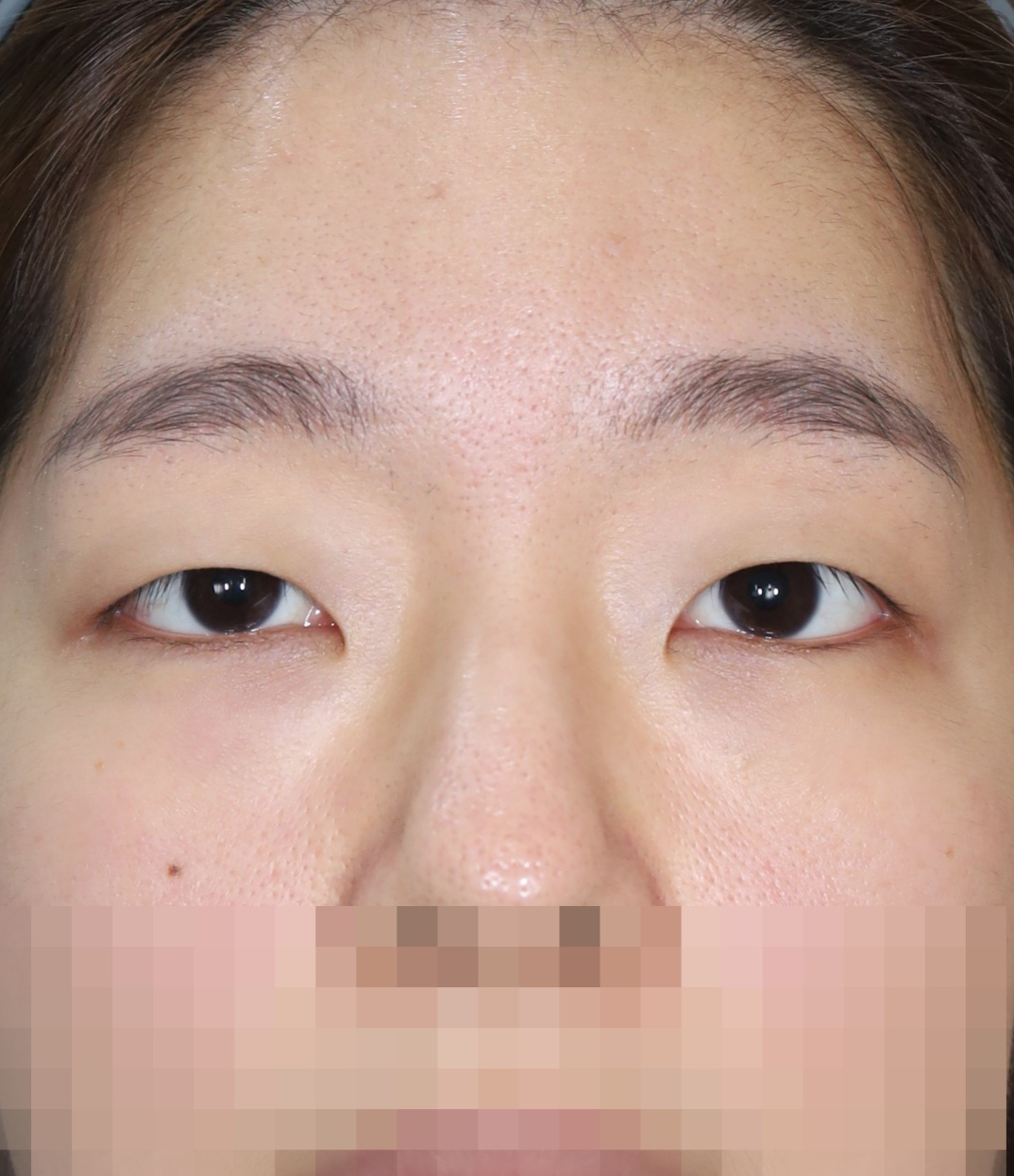 비절개 쌍꺼풀, 위트임, 눈밑 지방 재배치 2년 수술전