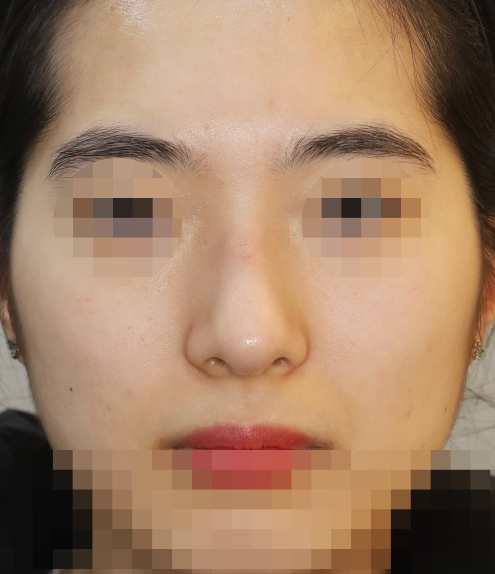 무보형물 코성형; 매부리코 교정, 휜코 교정 5개월 수술후