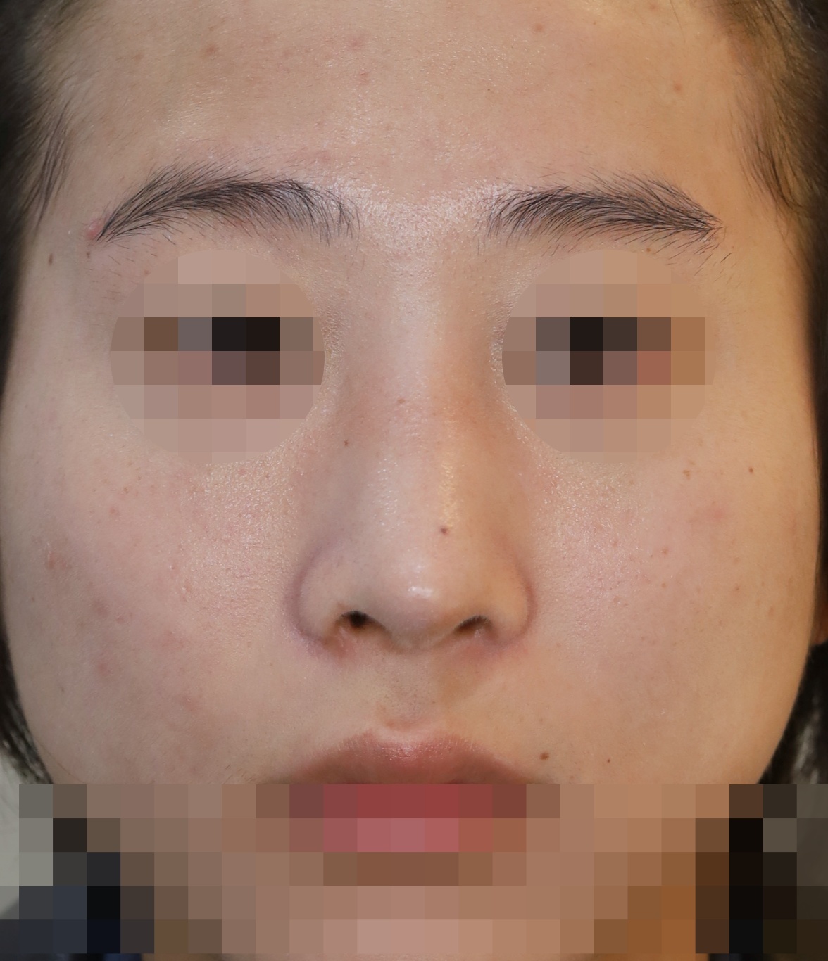 무보형물 코성형; 휜코 교정, 코끝 복원 5개월 수술후