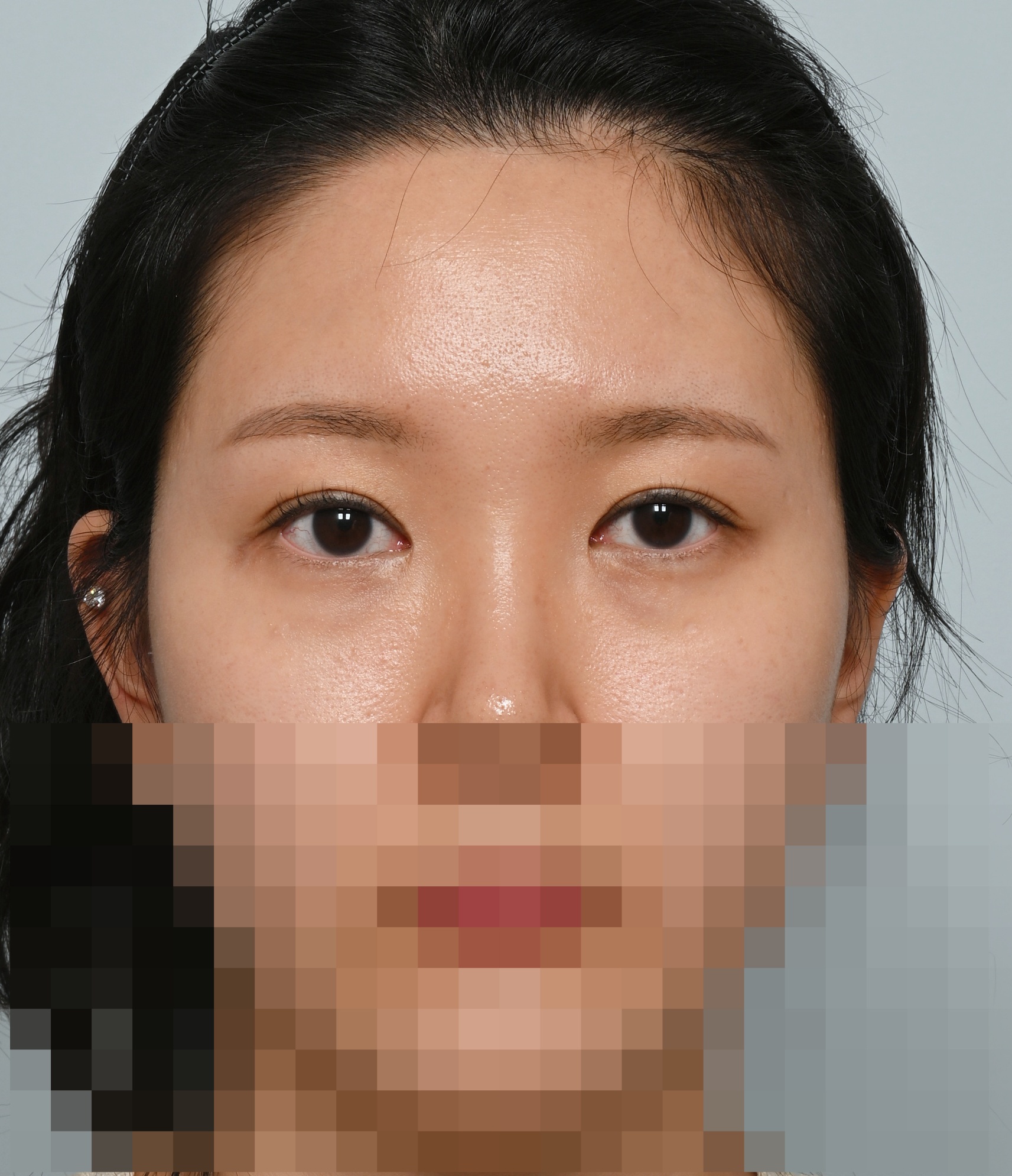 눈재수술(매몰, 앞위트임), 이마거상 1년 수술후